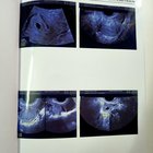 Need urgent help for my girlfriend’s surgical procedure (medical + ovarian cyst)